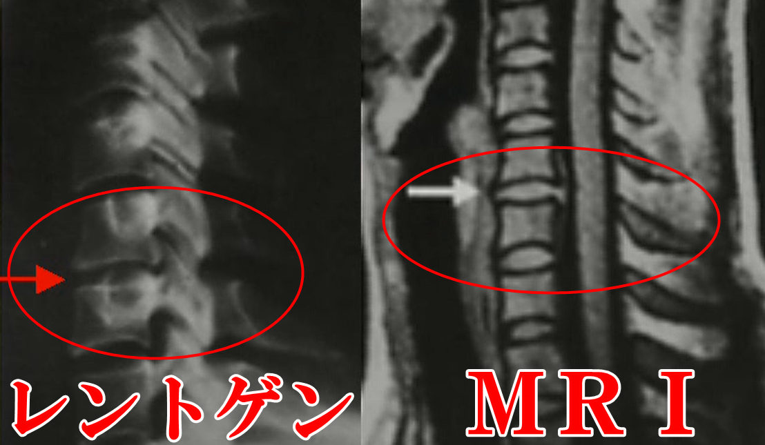 レントゲンとＭＲＩの比較