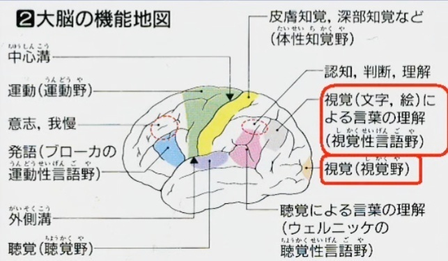 脳梗塞　後大脳動脈が詰まった場合