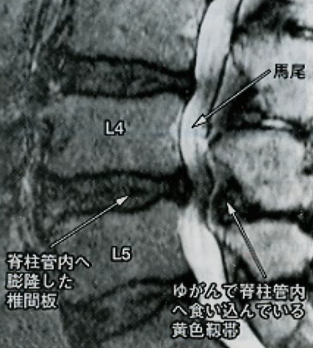 腰椎症の画像診断　ＭＲＩ画像