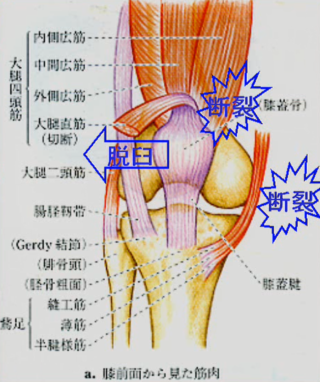 膝蓋骨の脱臼(外傷性)