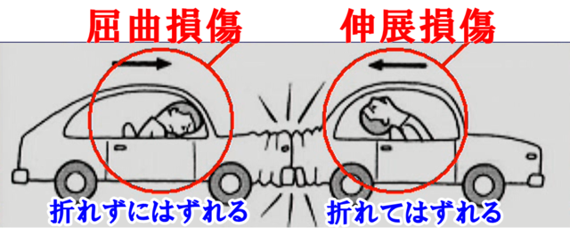 屈曲損傷と伸展損傷