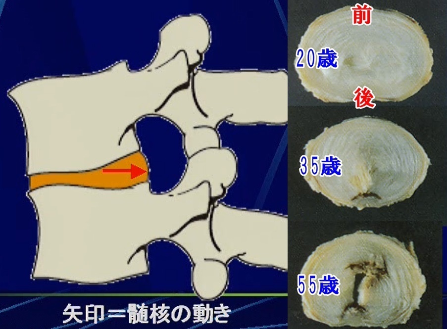 退行変性