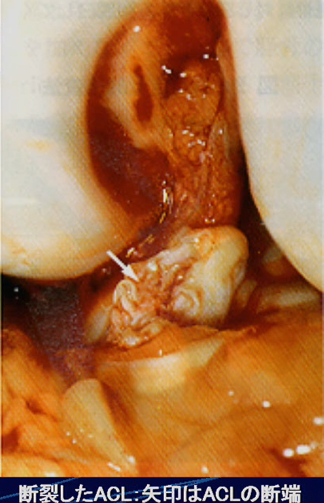 前十字靭帯(ＡＣＬ)損傷の病理