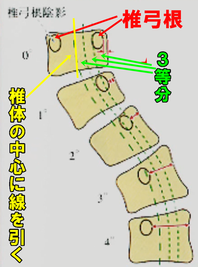 椎体のねじれ