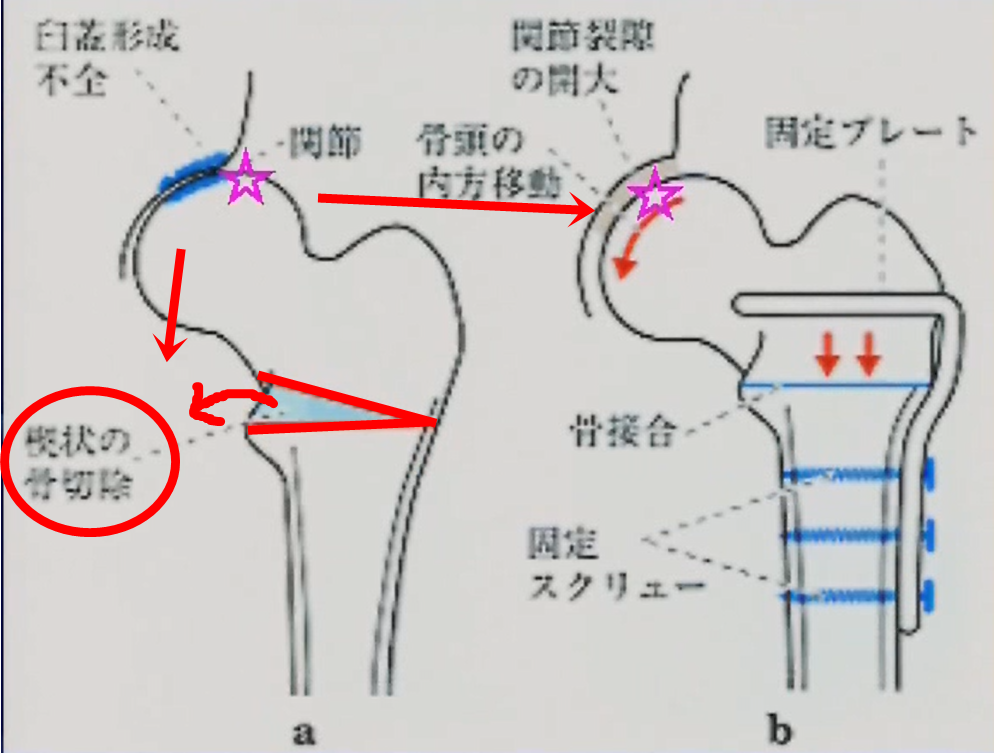 内反骨切り術