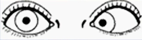 斜視（しゃし）