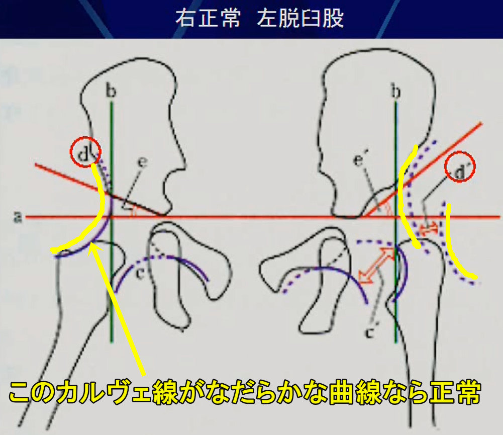 カルヴェ線