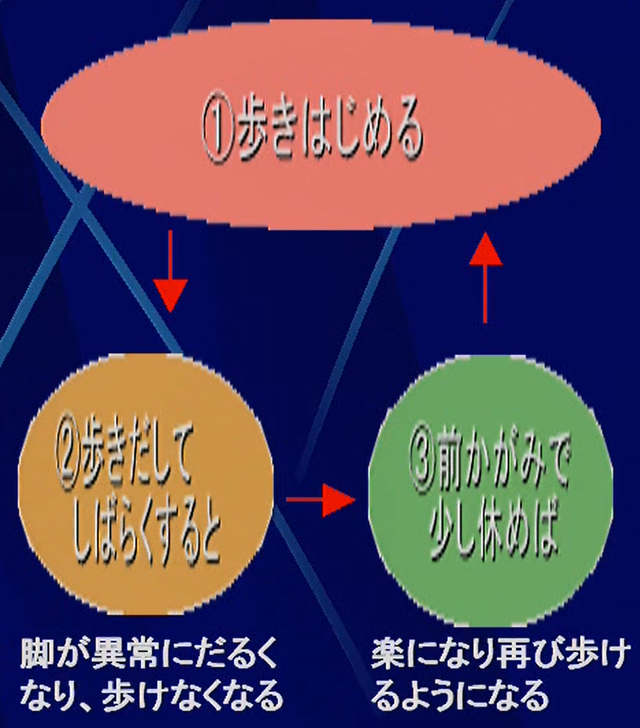 腰椎症　神経性間欠跛行