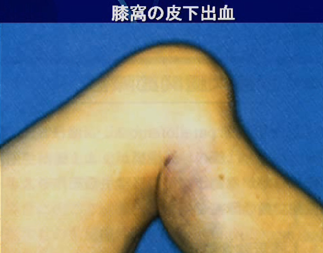 前十字靭帯(ＡＣＬ)損傷の画像