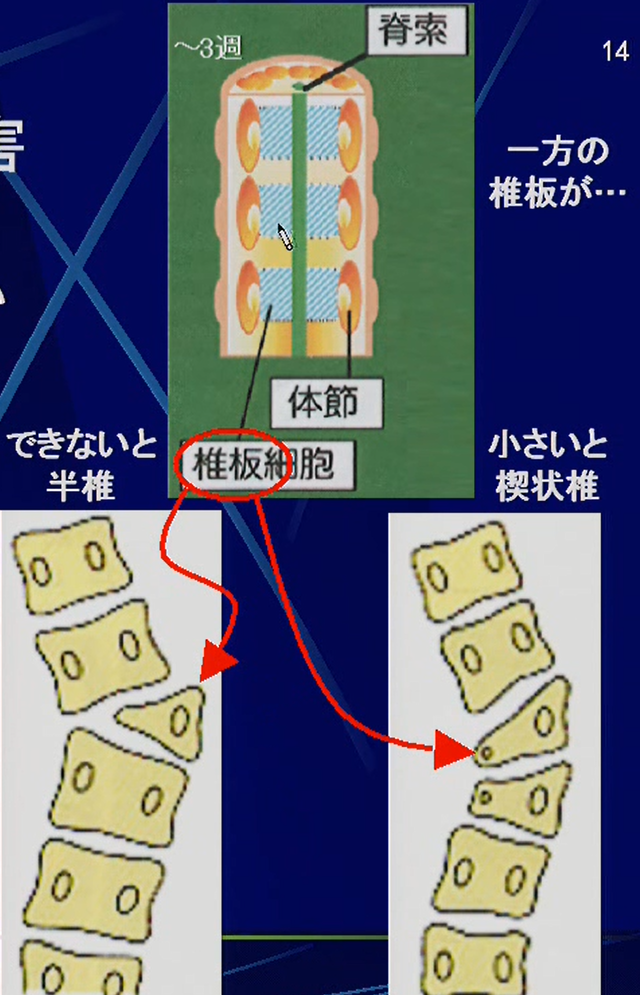 脊柱原基の形成・癒合の障害