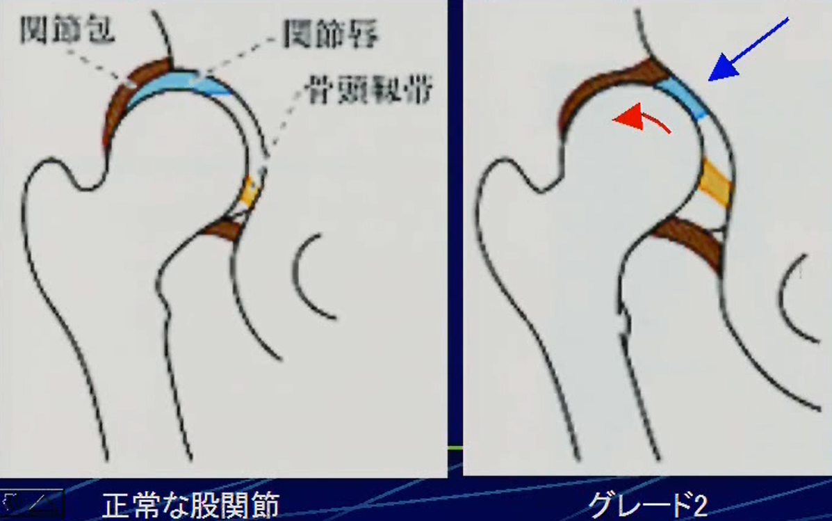 解剖学的グレード分類