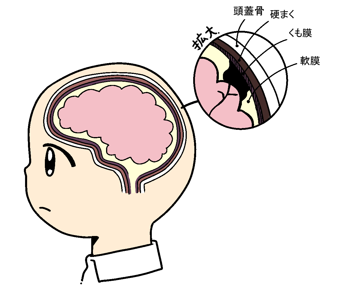 脳を保護する3層の膜と出血の分類
