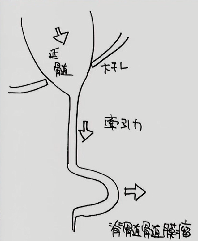 水頭症