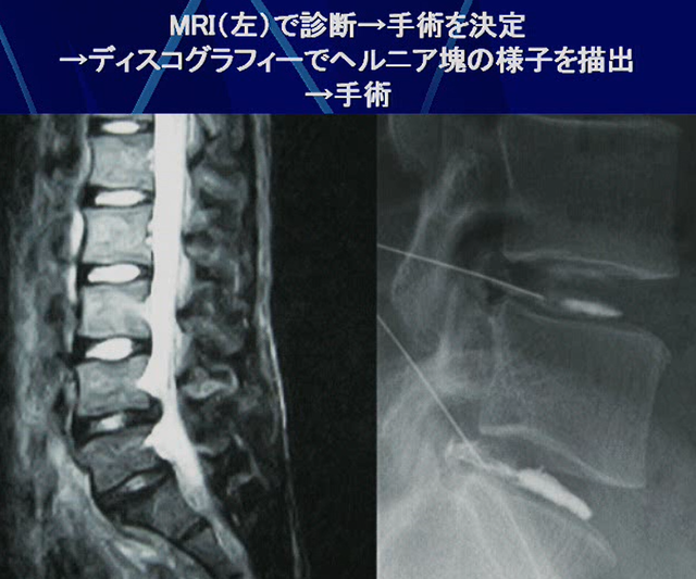 椎間板造影(ディスコグラフィー)の画像
