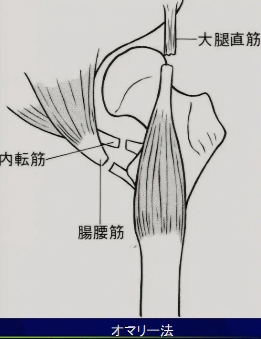 筋解離術(オマリー法)