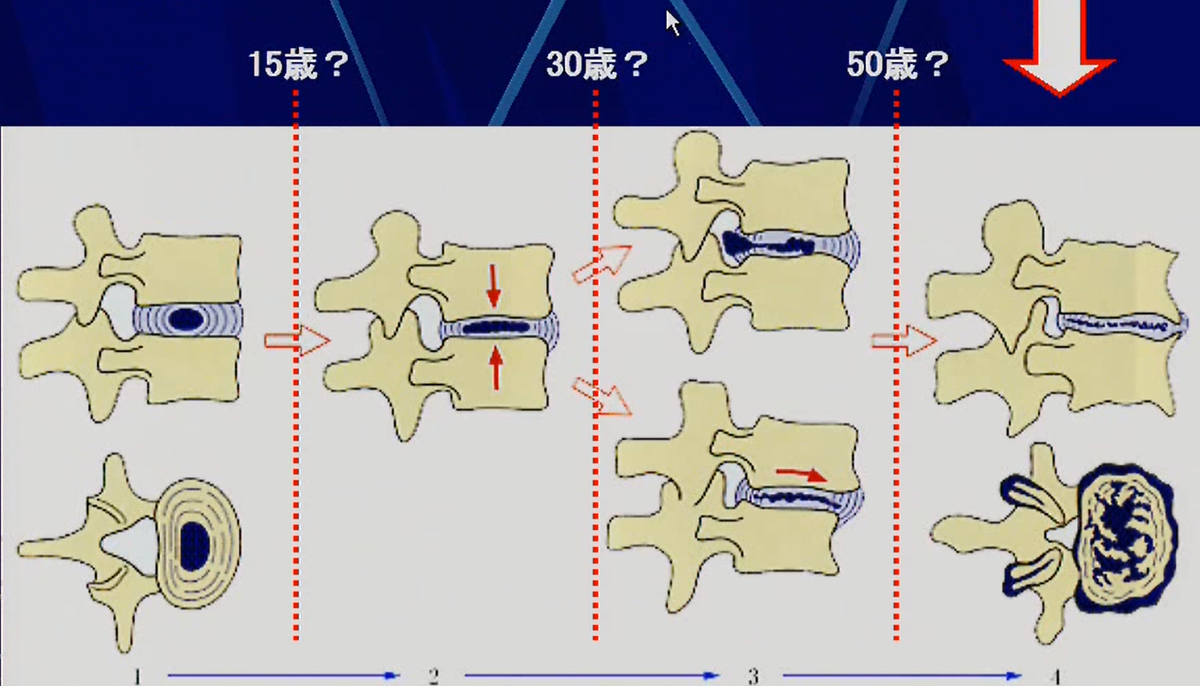 頚椎症　推移