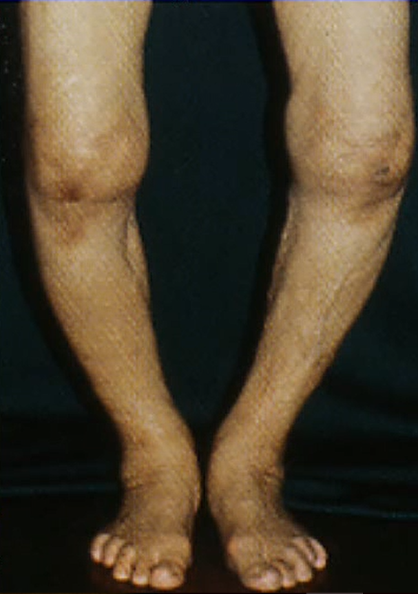 ＯＡ　Ｏ脚　変形性膝関節症