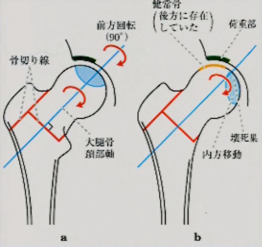 前方回転骨切り術