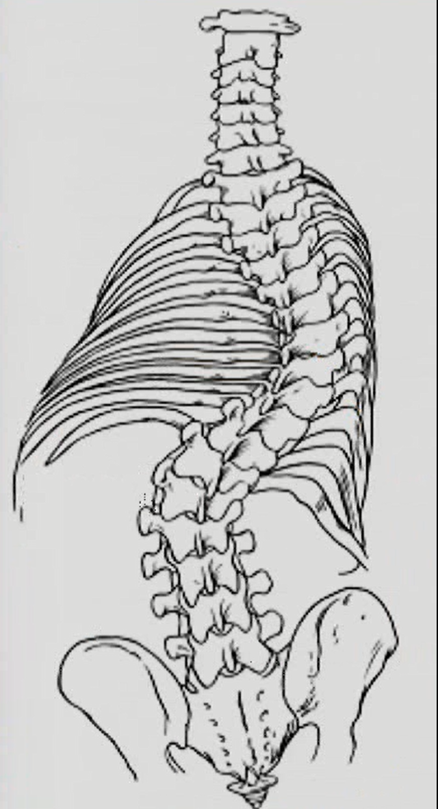 構築性脊柱側弯症