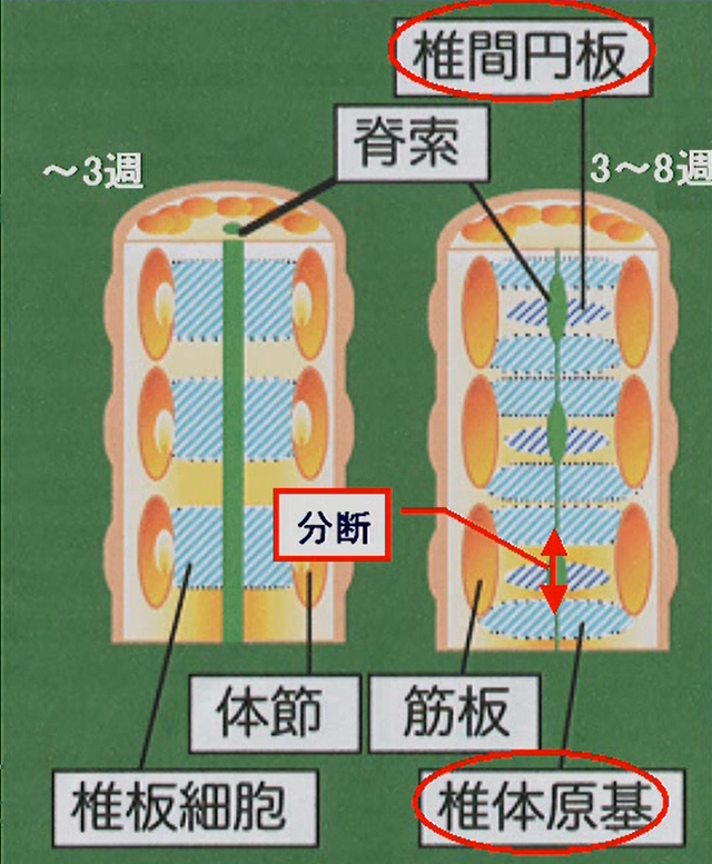 脊柱原基の形成・癒合の障害