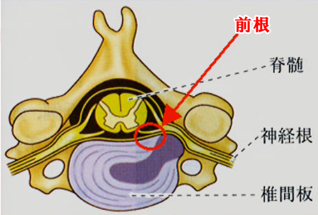 頸椎ヘルニアの線維性攣縮