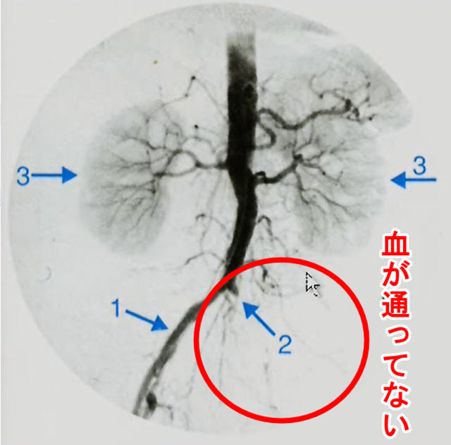 閉塞性動脈硬化症の血管造影