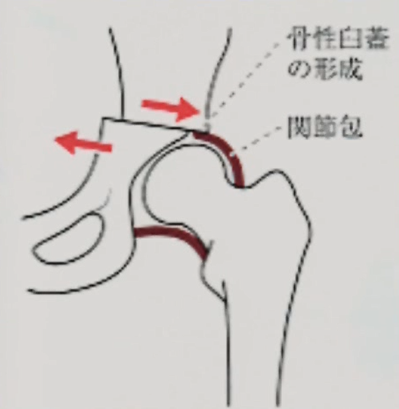 キアリ骨盤骨切り術