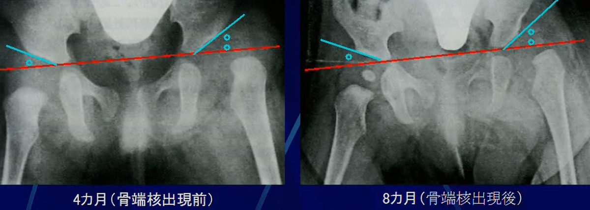 臼蓋傾斜角