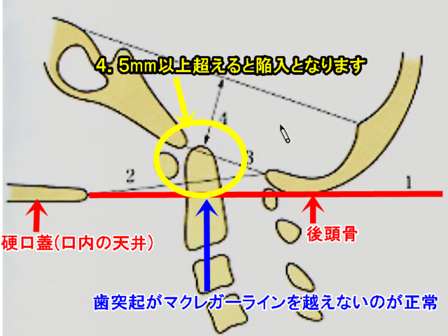 マクレガー線