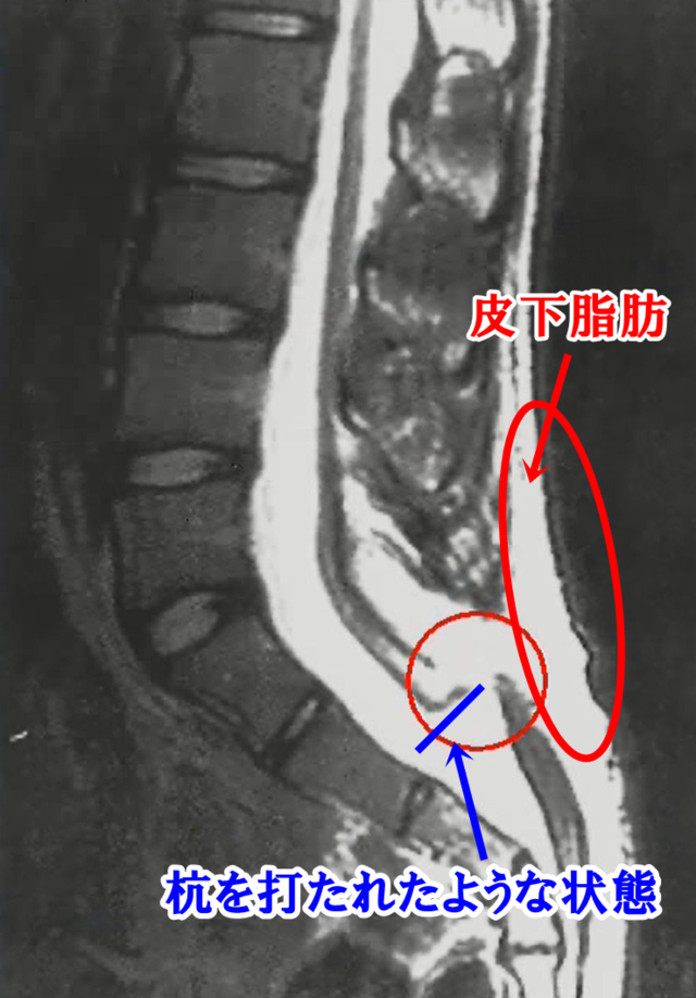 脊髄係留症候群