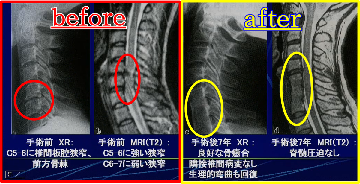 前方除圧・固定術を行った結果のレントゲン＆ＭＲＩ画像