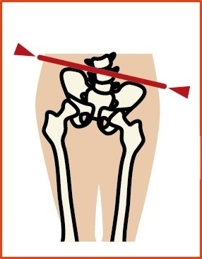 骨盤のゆがみ