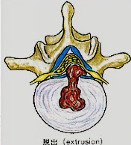椎間板ヘルニア　脱出
