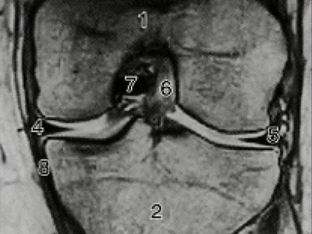 ＭＲＩで膝を正面から見た画像