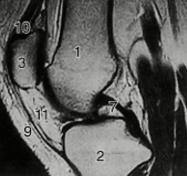 ＭＲＩで膝を横から見た画像