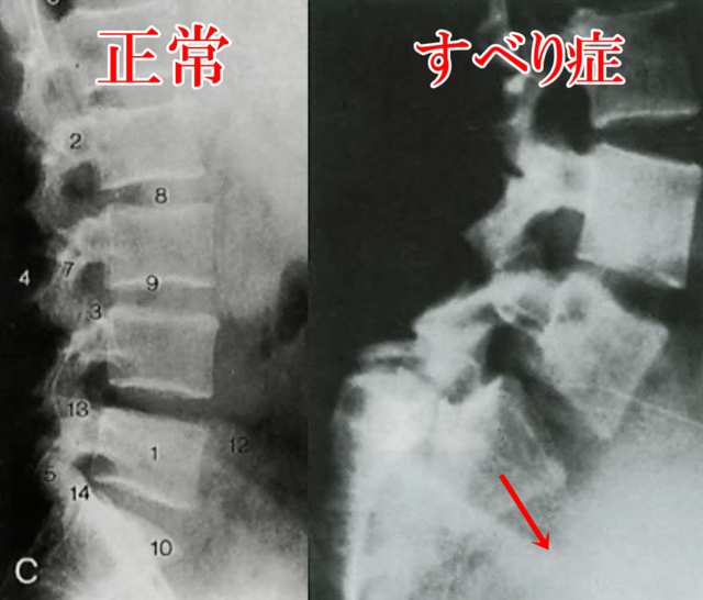 閉塞性動脈硬化症の血管造影