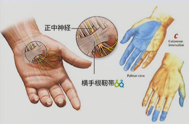 手根管症候群の病理