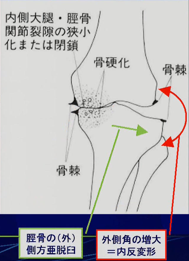 OA所見