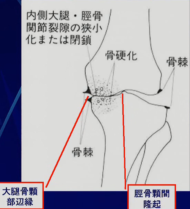 OA所見