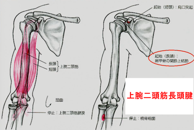 上腕二頭筋長頭腱の障害(断裂・腱炎)