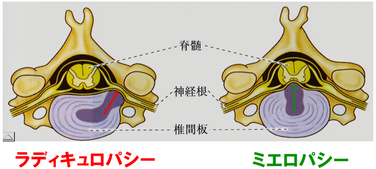 頸椎ヘルニア概要