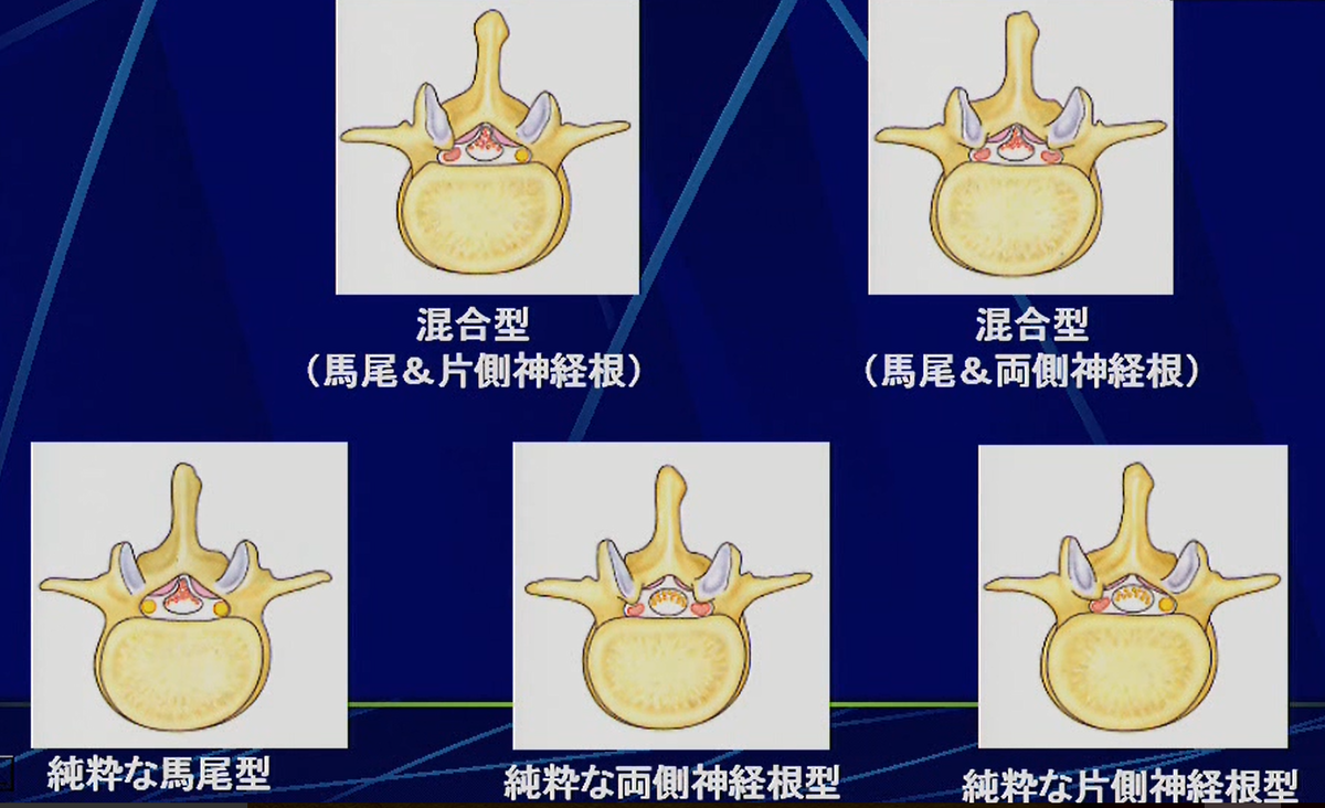 馬尾症候群と神経根症の鑑別は困難