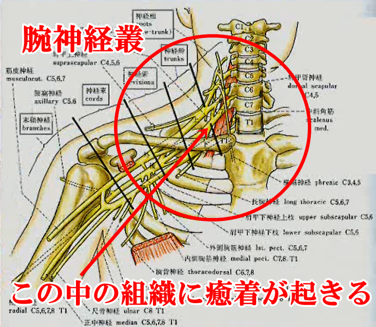 圧迫癒着