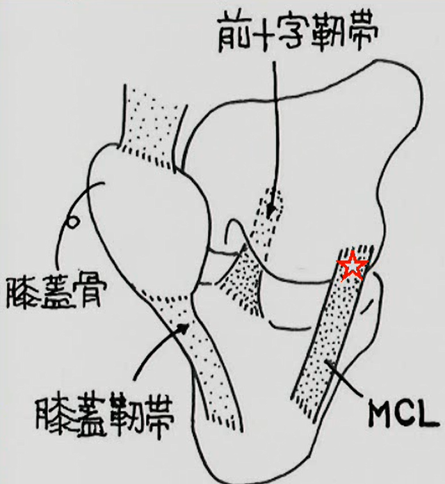 内側側副靭帯(ＭＣＬ)損傷