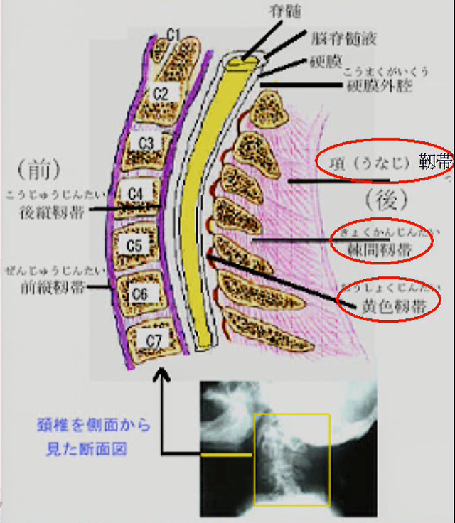 脊損における安定型