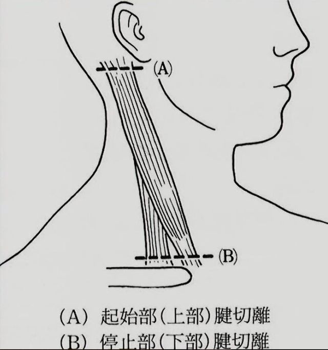 筋性斜頚手術