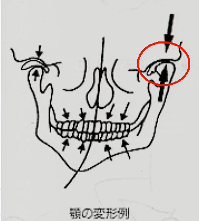 下顎の変形