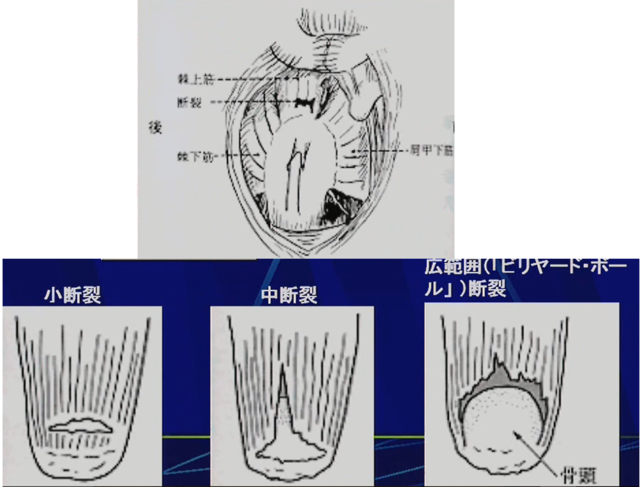 全層(完全)断裂