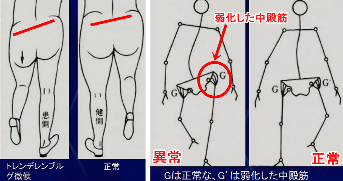 トレンデレンブルグ徴候(サイン)