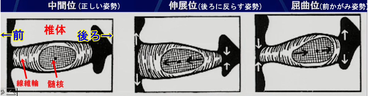 腰椎椎間板ヘルニア　力学的負荷による発症